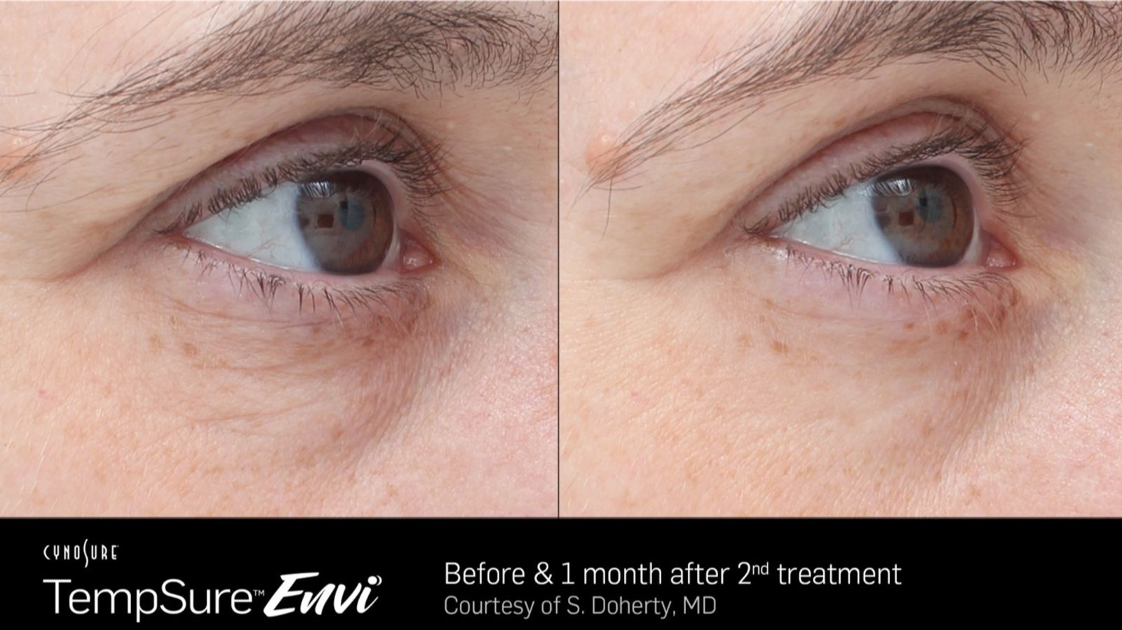 Skin Tightening Results