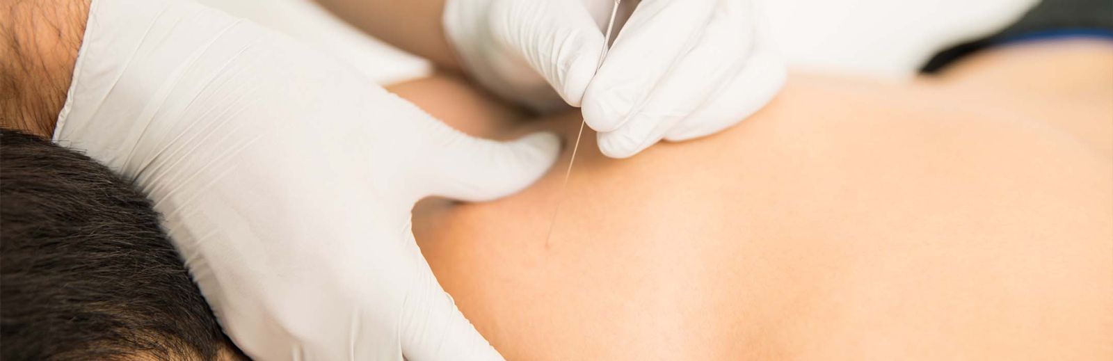 dry needling pain relief